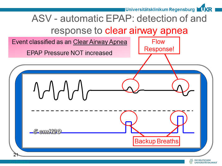 Clear Airway Apnea Technology of Servo Ventilation Activity Three