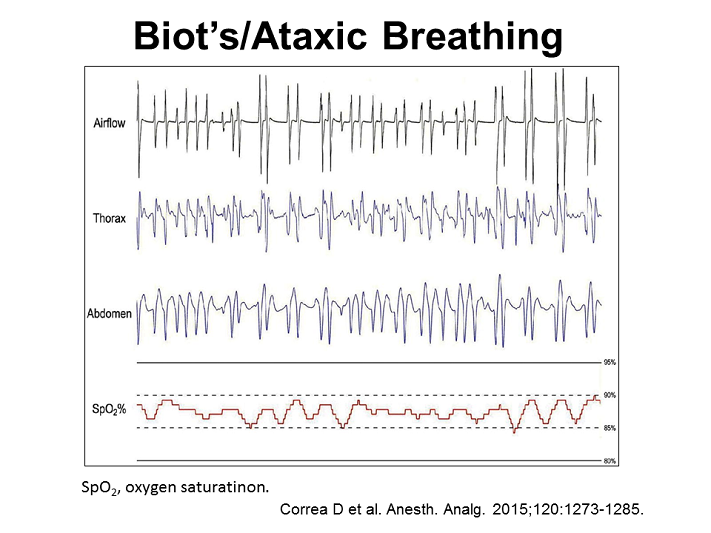 Another pattern of OpCSA may be Biot’s or ataxic breathing Opioid
