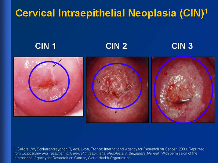 cervical-intraepithelial-neoplasia-cin-your-child-and-the-hpv