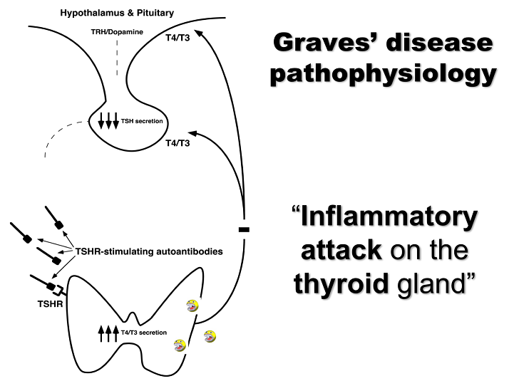 Graves Disease Pathophysiology Presentation TSHReceptor Antibodies