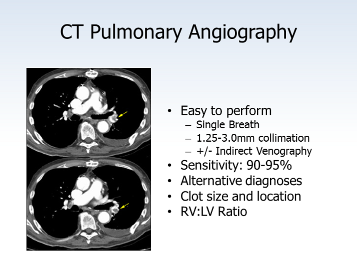 Ct Pulmonary Angiography D Dimer Testing In Emergency Settings