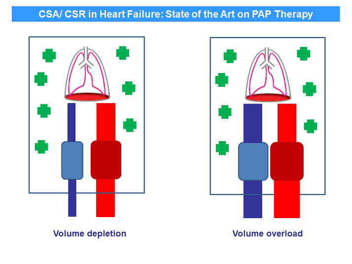 Volume Depletion and Volume Overload Managing Sleep Disordered