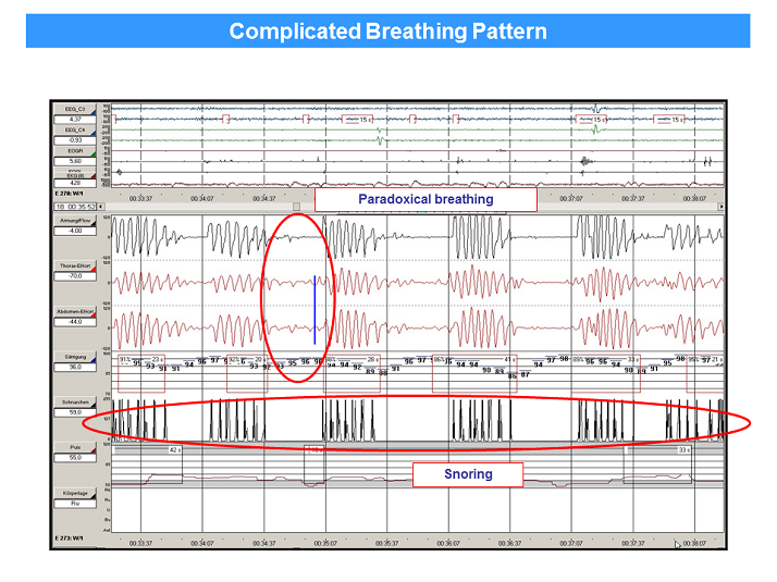 Paradoxical Breathing Pattern