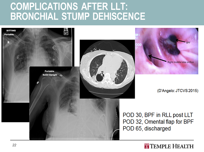 Complications after LLT Bronchial Stump Dehiscence Surgical Approach